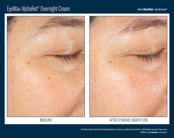 EyeMax™ AlphaRet® Overnight Cream